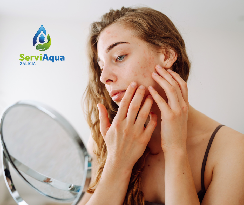 problemas de piel por agua